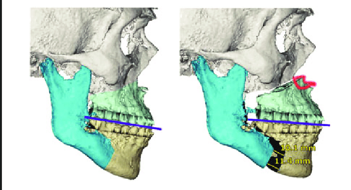 CCW rotation of the maxillomandibular complex A 3D VSP of an MMA demonstrating MMA with