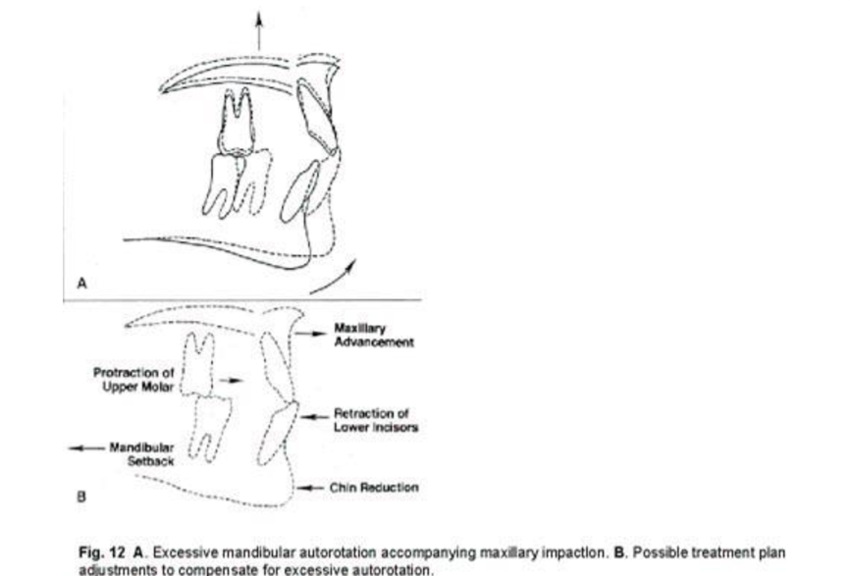 A Excessive mandibular autorotation accompanying maxillary impactlon B Possible
