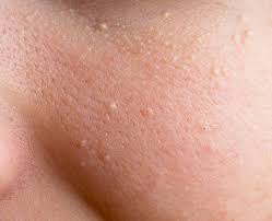 Milia (Milk Spots): Causes & Treatment