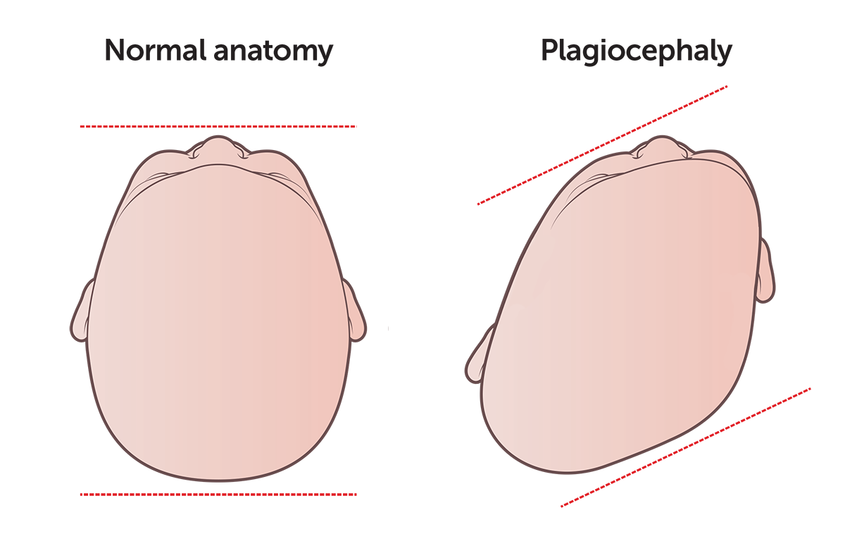 20241003 KHI Plagiocephaly Illustration Plagiocephaly 1