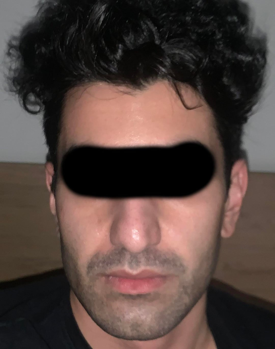 Before and after m filler cheek 1