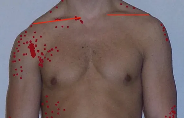 Clavicle lines parallel sloping down with lines