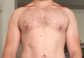 Clavicle low shoulder lines