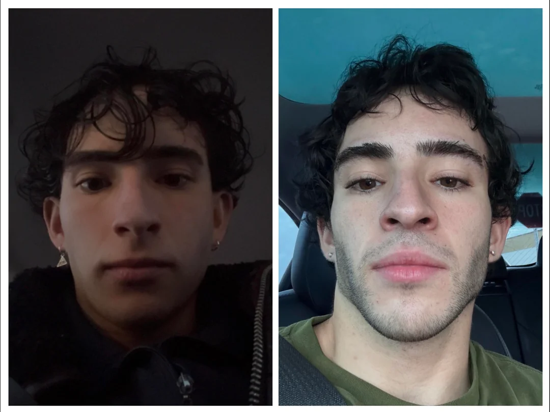 9 months post op djs why you shouldnt base your decision on v0 3owivjekut4g1