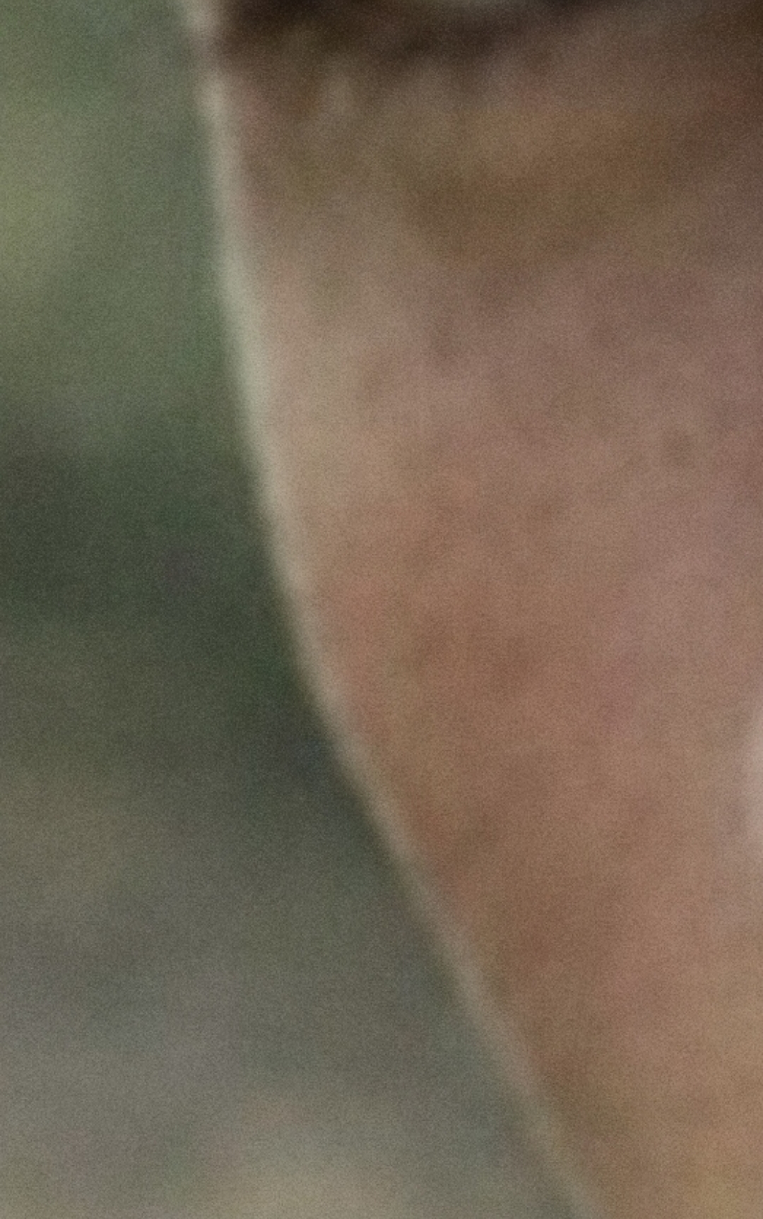 Zygo Implant Before 19112009