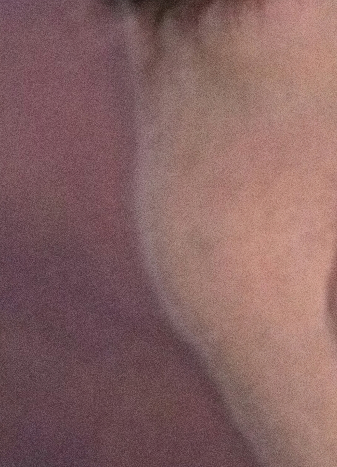 Zygo Implant After 17022010