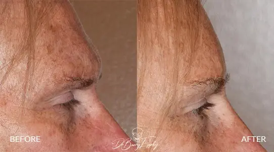 Ba transgender brow bone reduction