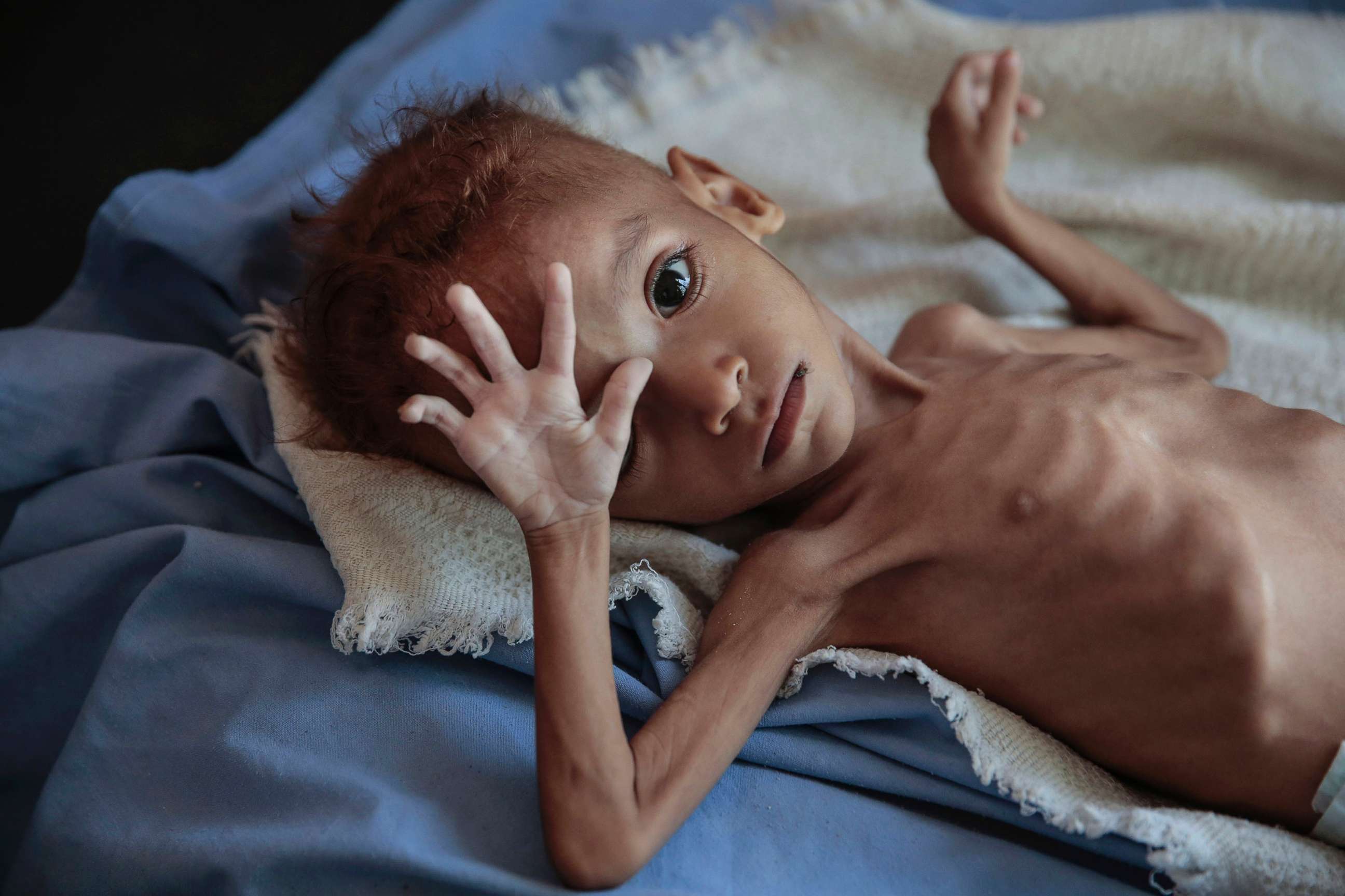 Yemen hunger child ap ps 181121 hpMain 1