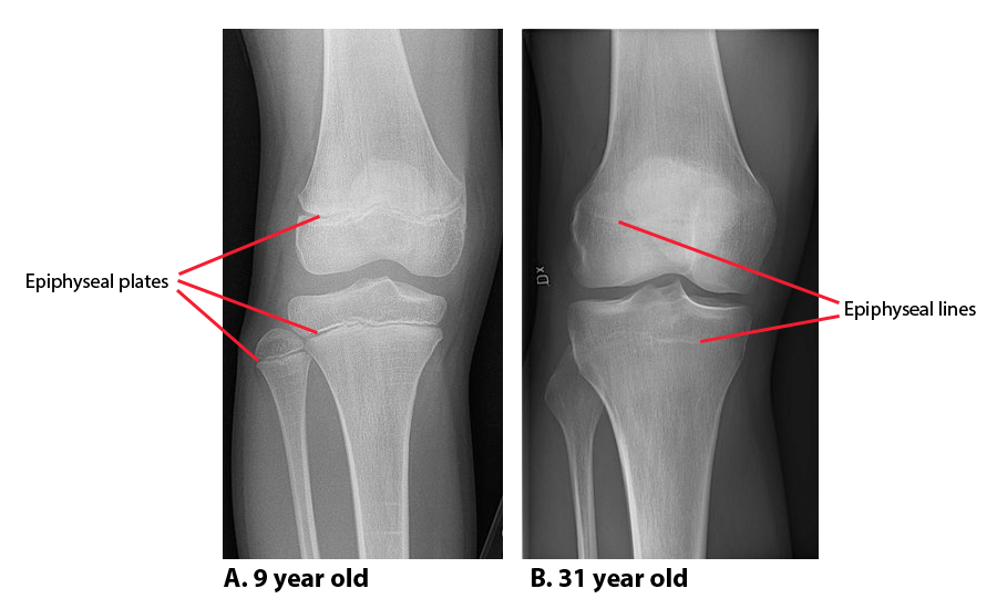 X ray of the knee anteroposterior comparison 9yo 31yo