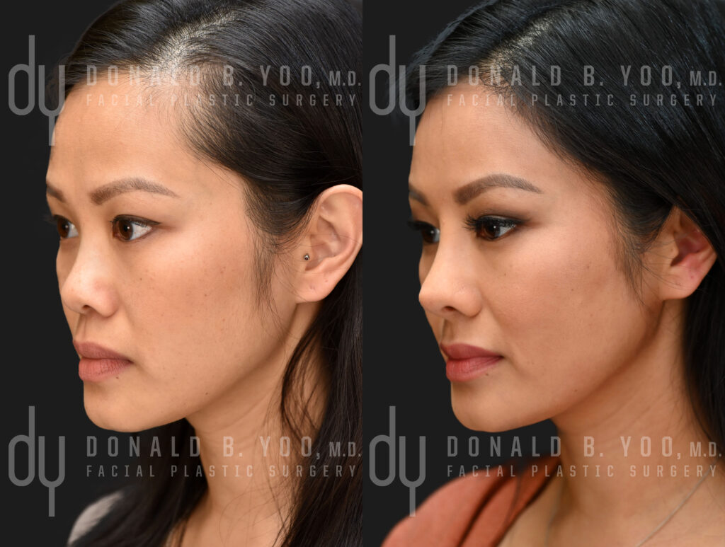 PC Asian Rhinoplasty Left 3qt View copy 1024x773