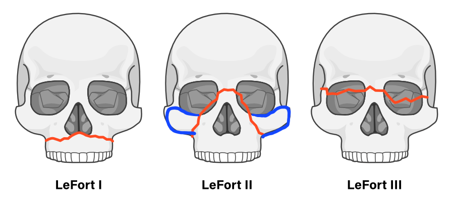 LeFort Midface Fracture Classification