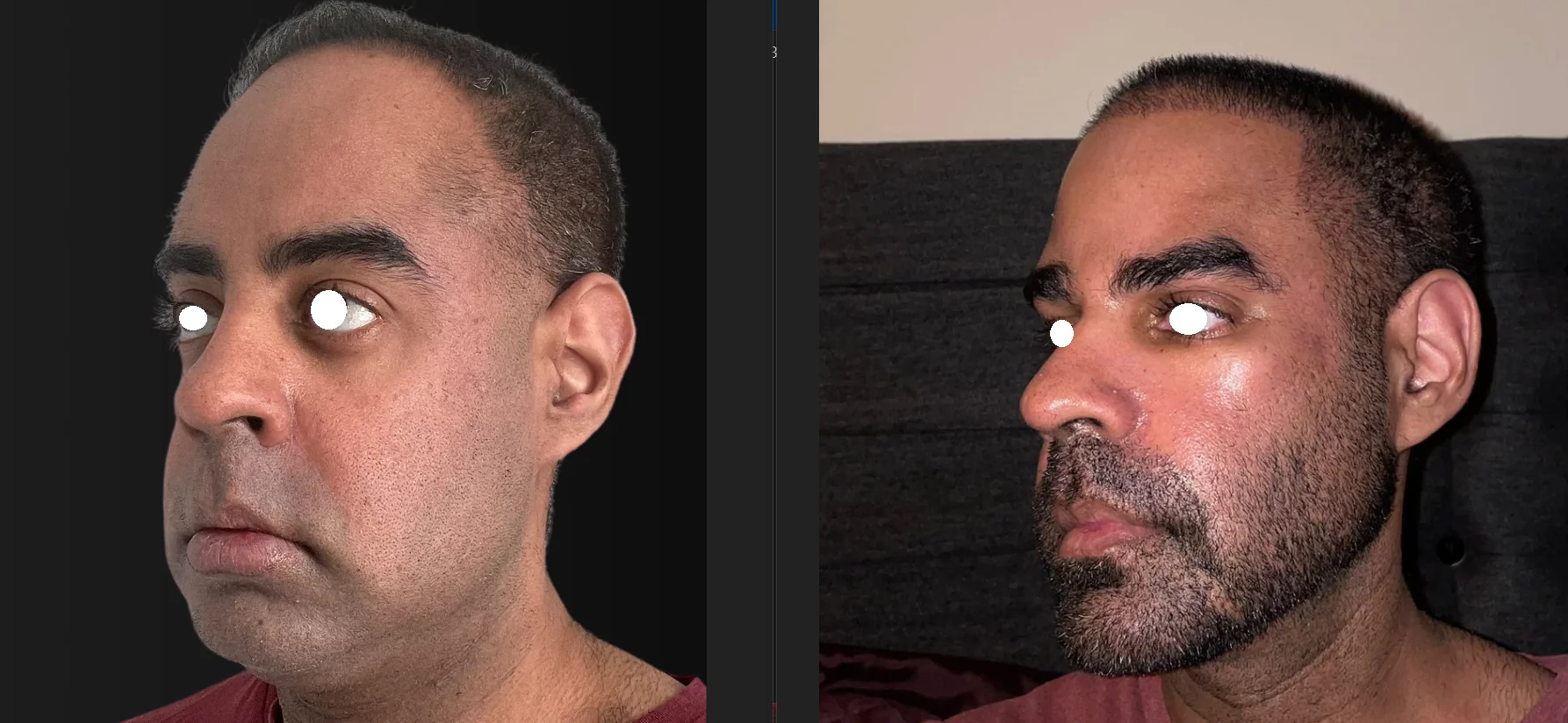 3857028 thank you dr pagnoni and liam revision double jaw surgery v0 qvqr7sg7u49c1