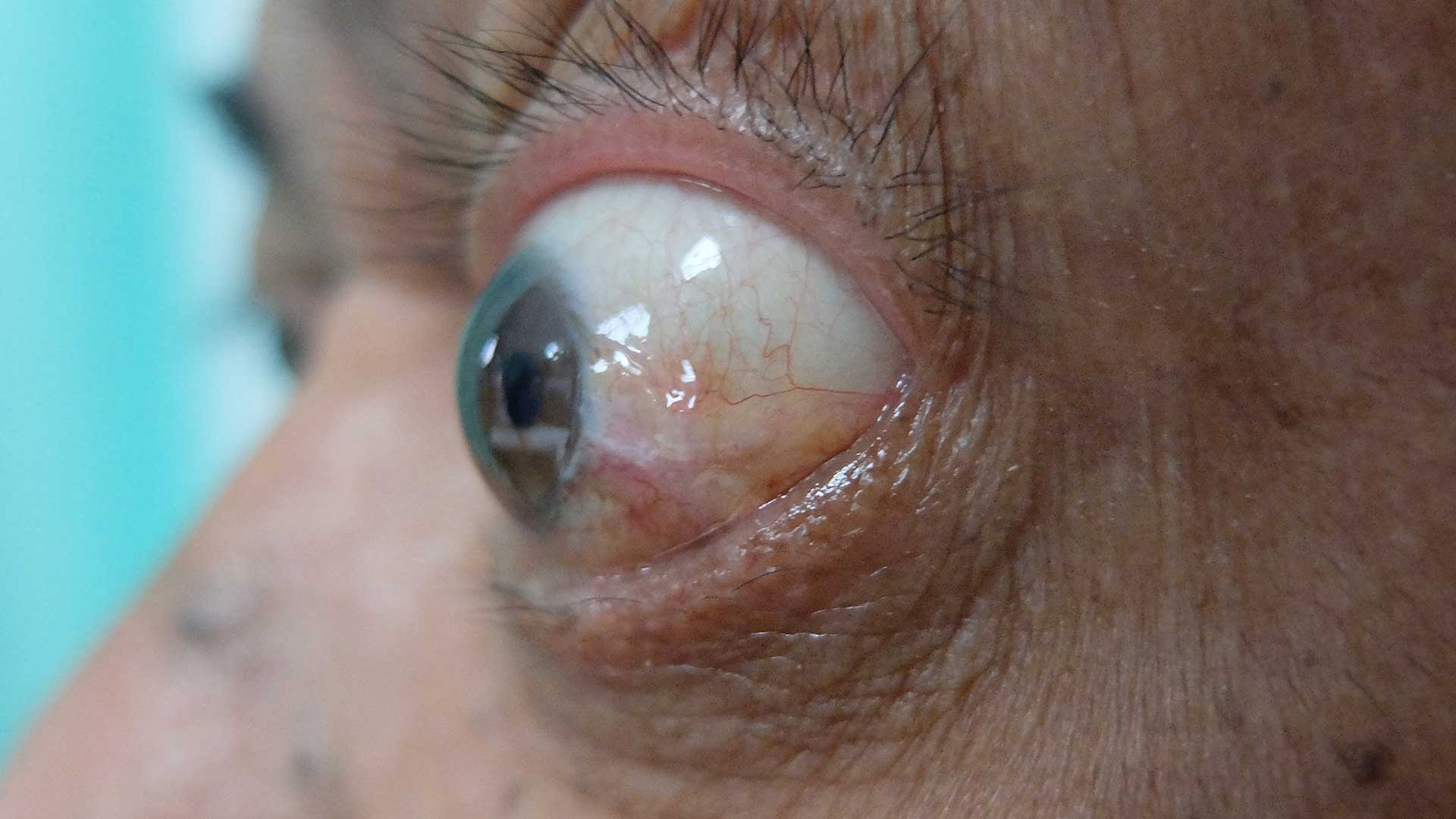 Blog image prorotosis TED