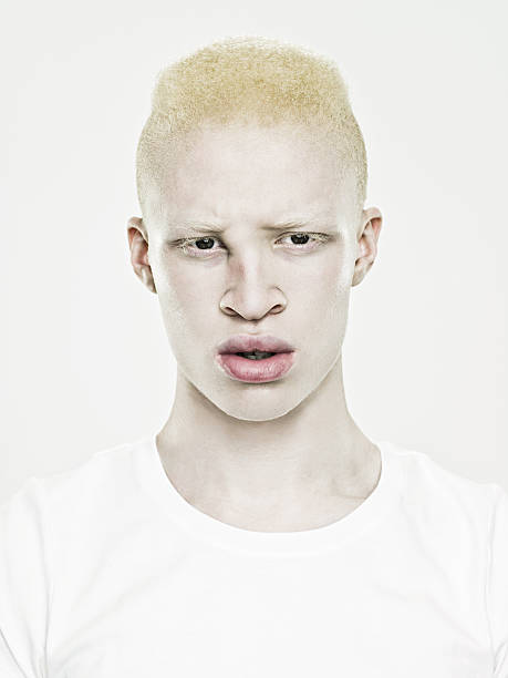 Headshot of a young albino man