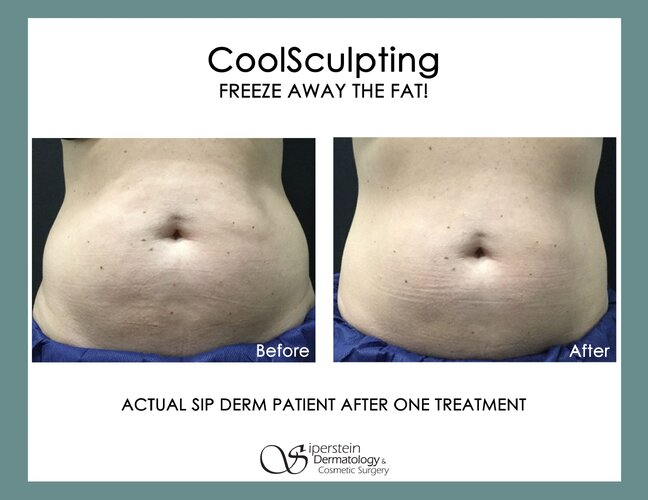Coolsculpting24rev 1 scaled