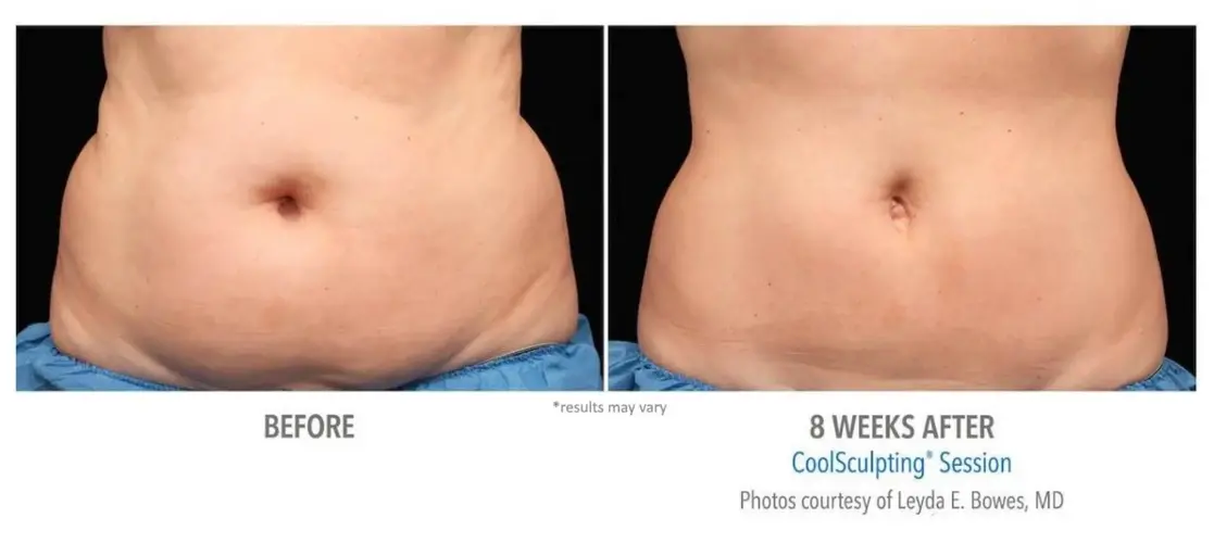 Necbs coolsculpting before after 4