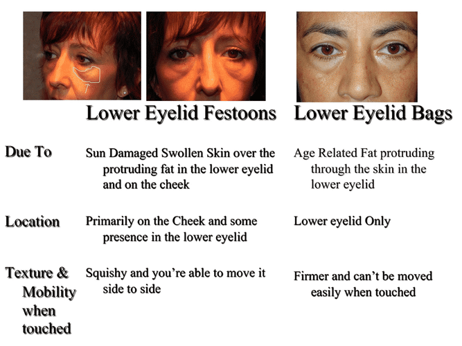 Festoons-vs-Lower-Eyelid-Bags.png
