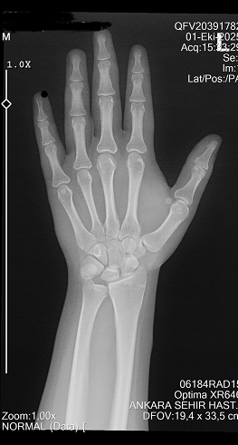 büyüme plakları.PNG