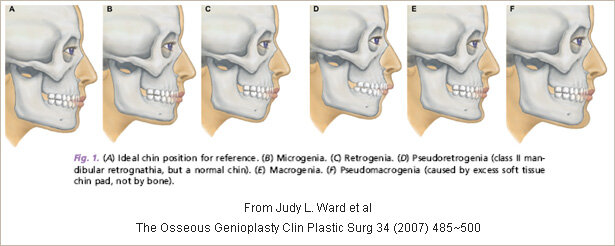 _Mandibular prognathism1.jpg