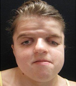 Le fort iii teenager craniofacial surgical management revised july 2017 780x439