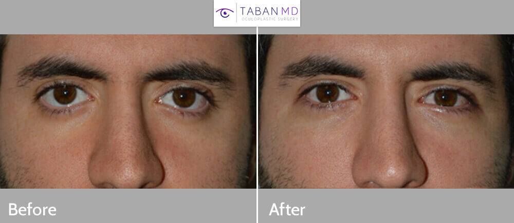 How to Get Attractive Eyelids 1 1 1 1