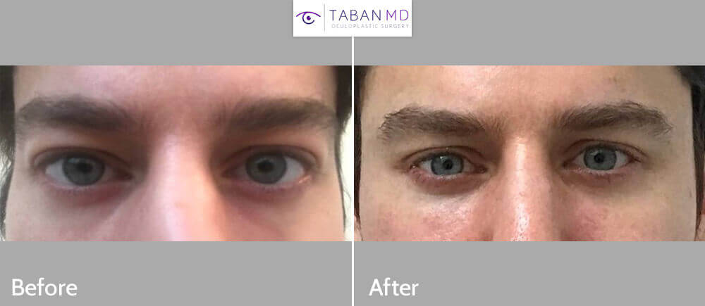 Almond eye surgery Before and After Patient 28 Dr Taban 1