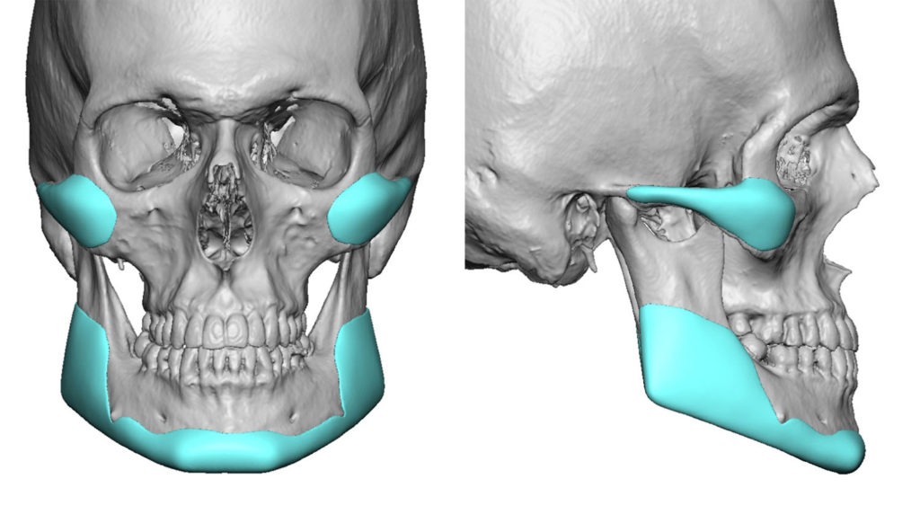 Total Face Implants | Eppley Custom Facial Implants