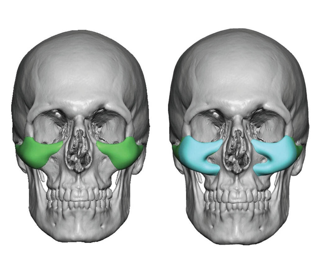 Custom Midface Implants - Cheek Implants | Eppley Custom Facial Implants