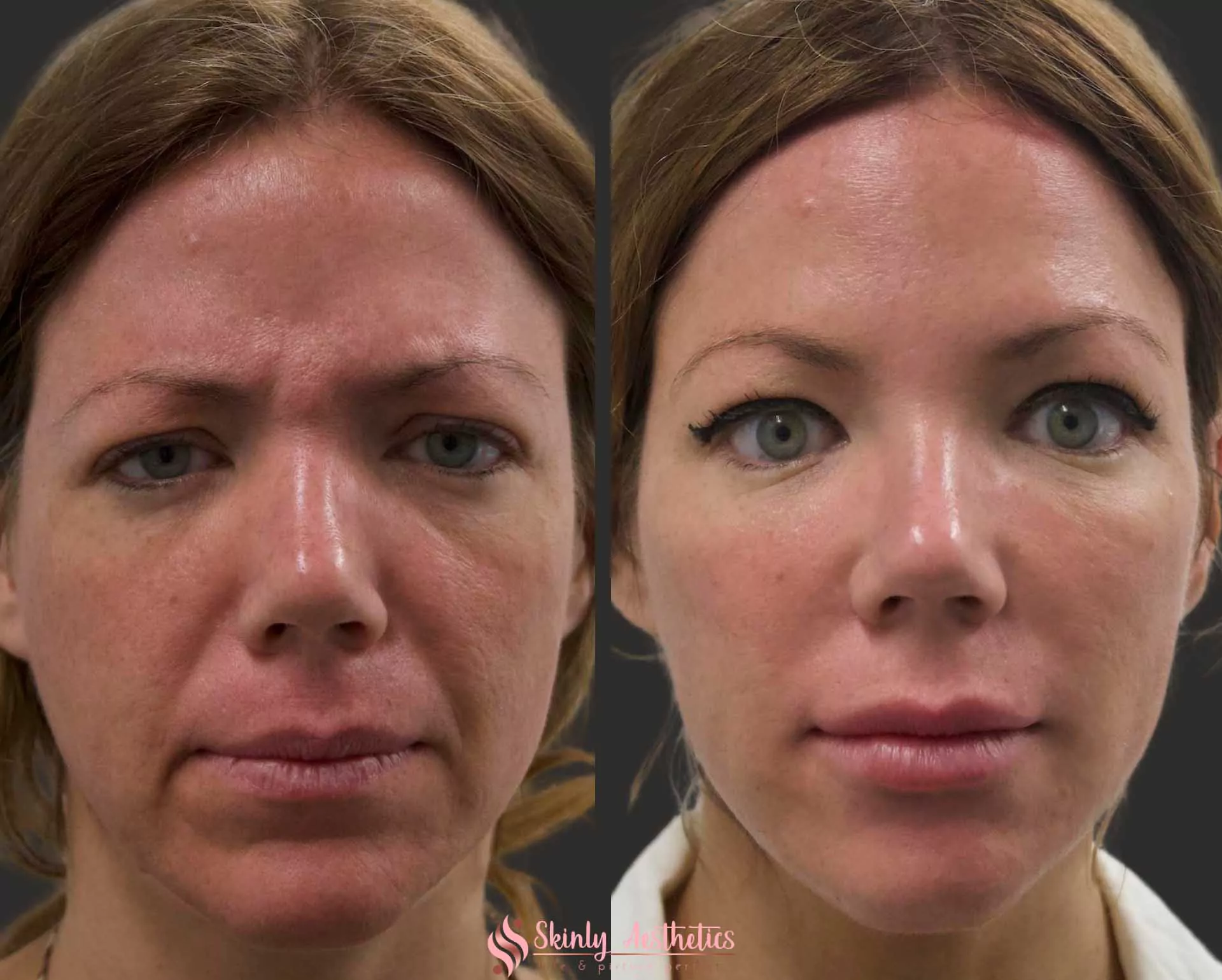 Nasolabial fold correction with Juvederm filler