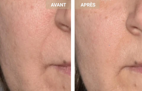 Masque avant apres rides du sillon nano genien 480x480 2