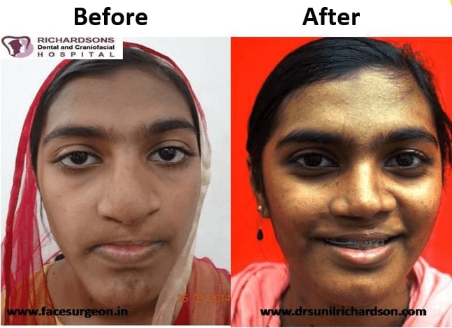 Rhinoplasty nose job surgery in india