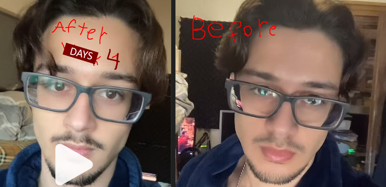 4days of nose reduction