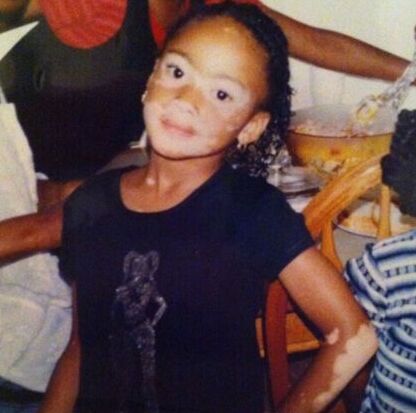 151204114619 winnie harlow childhood photo 2 2