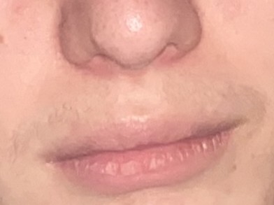 Philtrum front