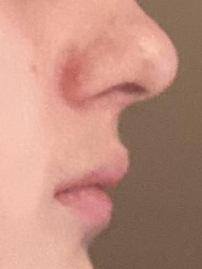 Philtrum side
