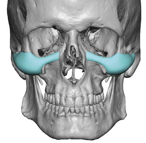 male-custom-infraorbital-malar-cheek-implants-design-front-view-Dr-Barry-Eppley-Indianapolis.png
