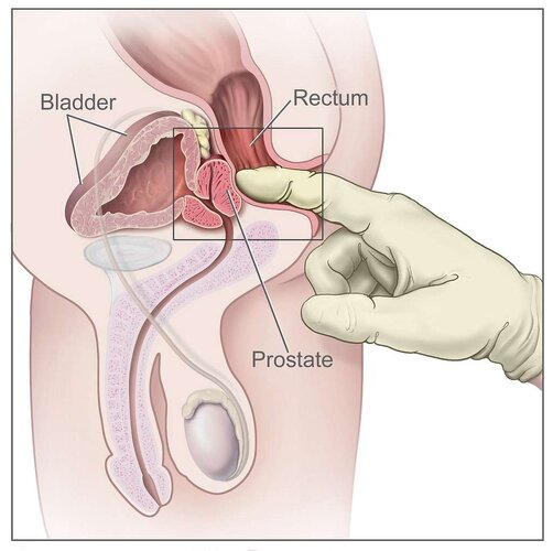 digital-rectal-exam-2f7384-1024.jpg