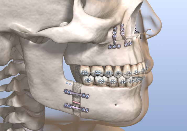 Double jaw surgery