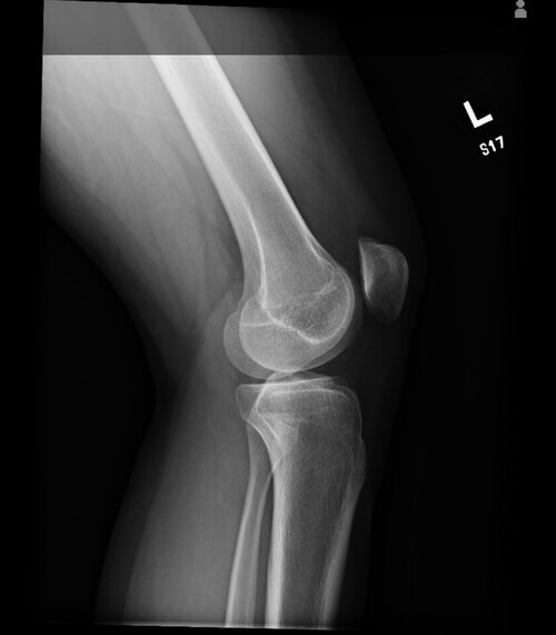 DashKneeXray_3.jpeg
