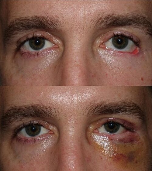 Martinez-J-LL-recon-skin-flap-canthoplasty-margin-rotation-midfacelife.jpg