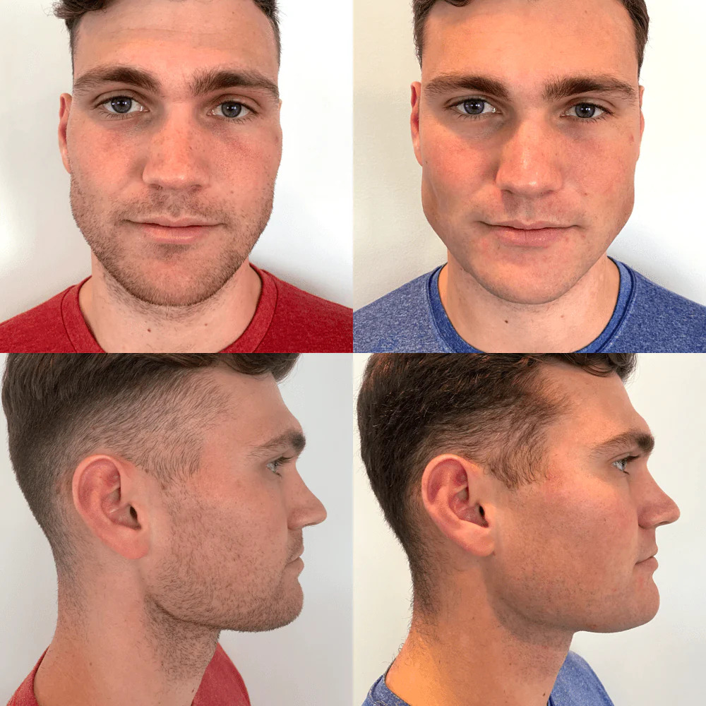CHISELL Before and After review result 1024x1024