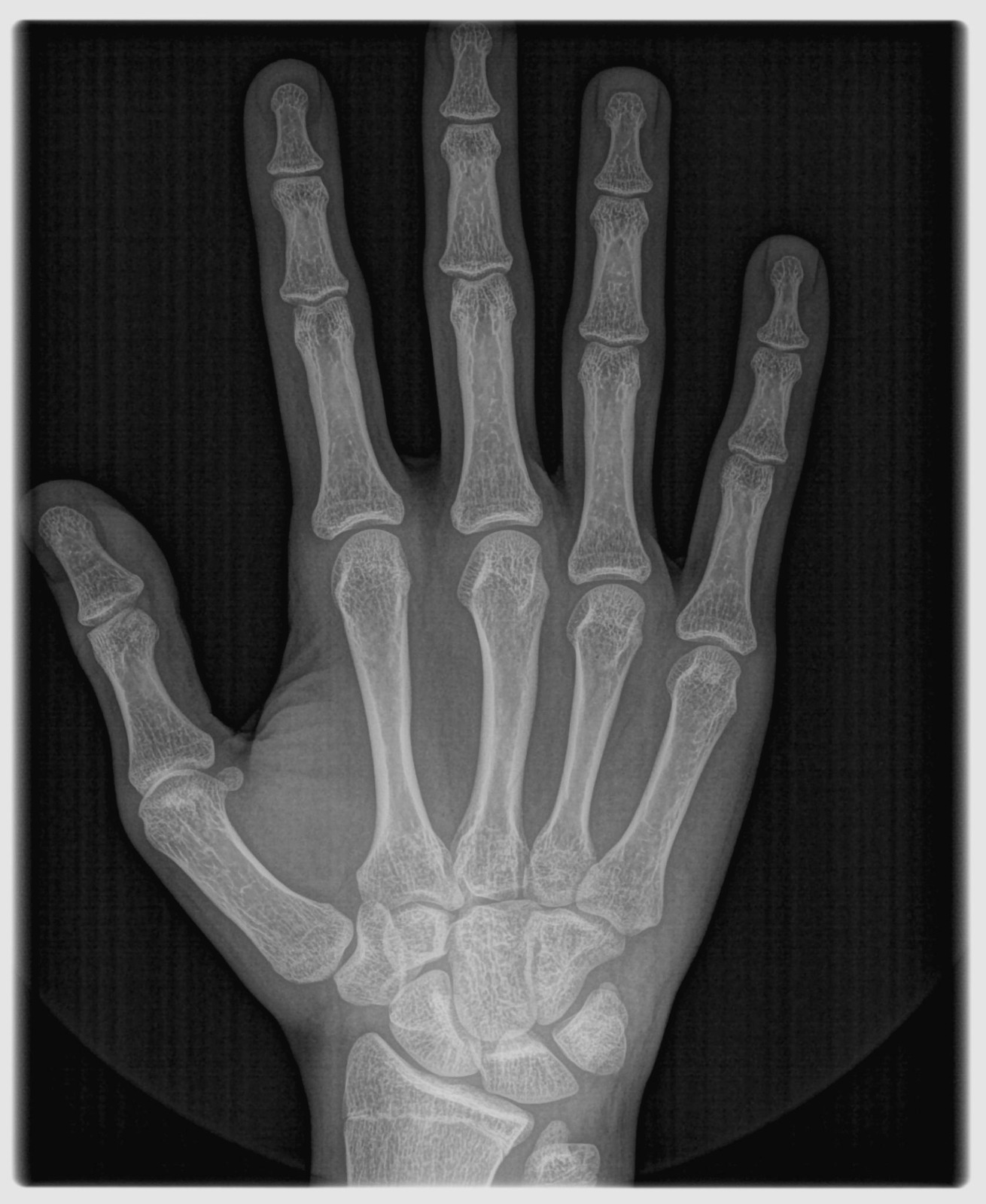 Xray hand