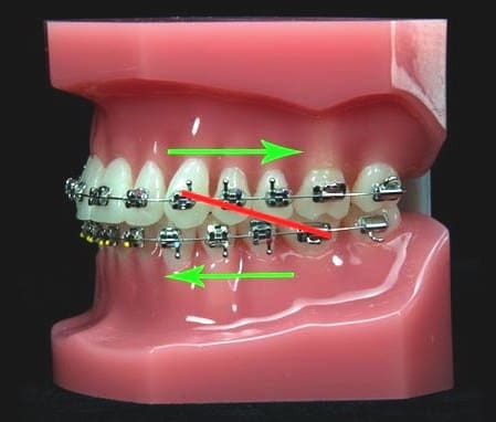 Class II braces 1lvk 2