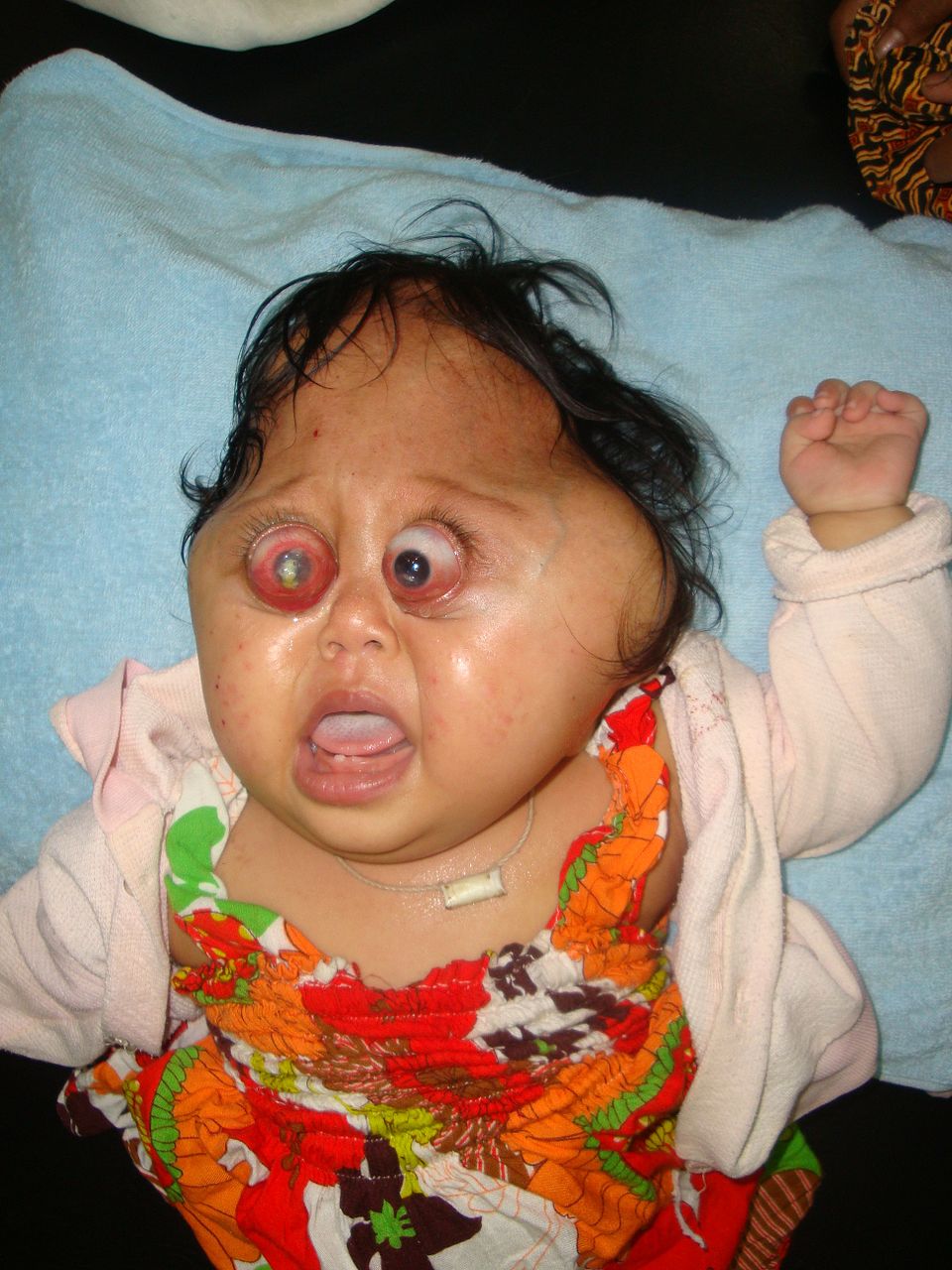 960px Crouzon Syndrome