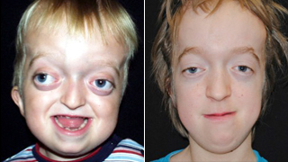 5940955 before after craniosynostosis syndromic crouzon demalik 16x9 320x180