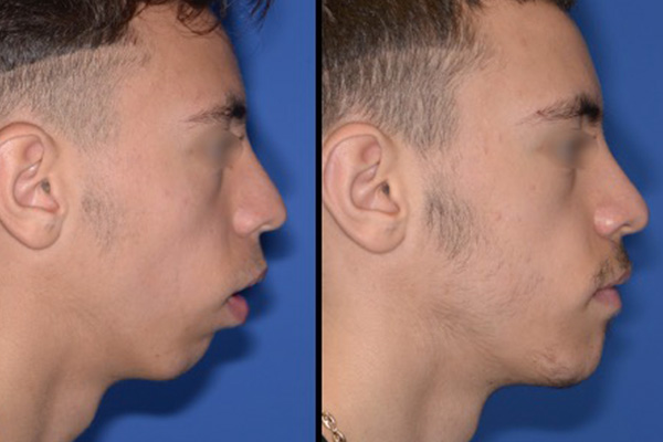 Osteotomie mandibulaire post operatoire dr paul moulin chirurgien maxillo facial specialiste c
