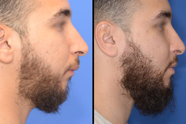 Chirurgie osteotomie mandibulaire dr paul moulin chirurgien maxillo facial specialiste chirurg