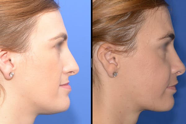 Osteotomie maxillaire d abaissement dr paul moulin chirurgien maxillo facial specialiste chiru