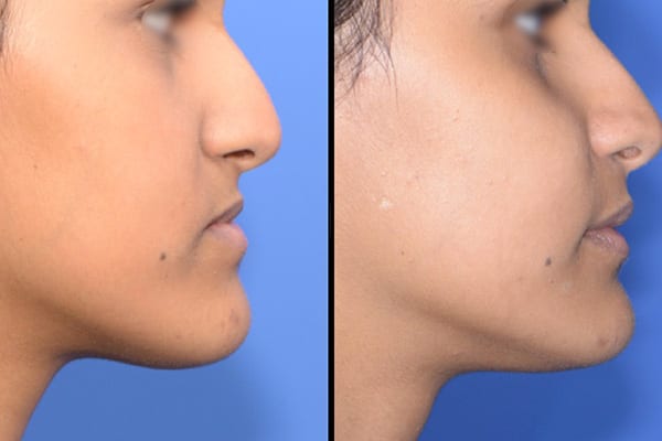 Chirurgie maxillo facial avant apres dr paul moulin chirurgien maxillo facial specialiste chir