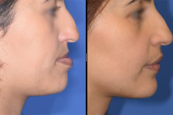 Chirurgie orthognatique avant apres docteur paul moulin chirurgien maxillo facial paris